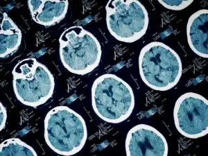 brain injury scans